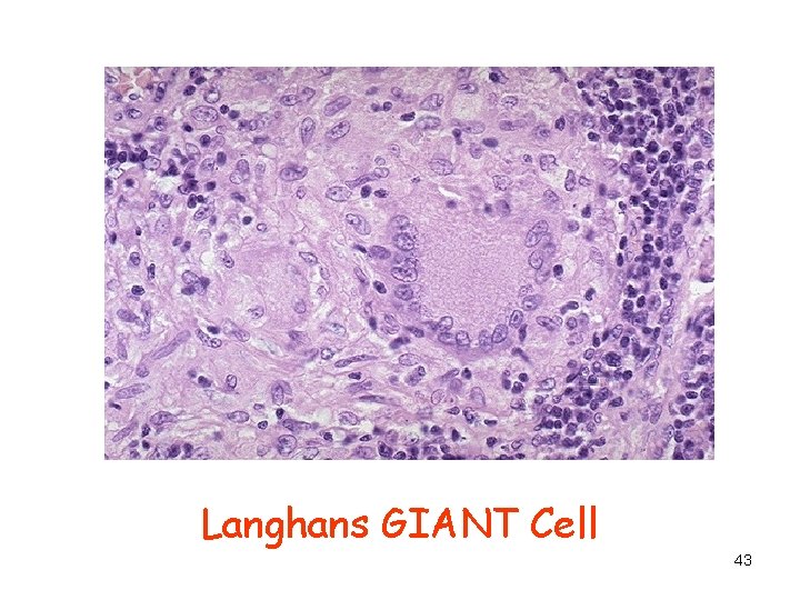 Langhans GIANT Cell 43 