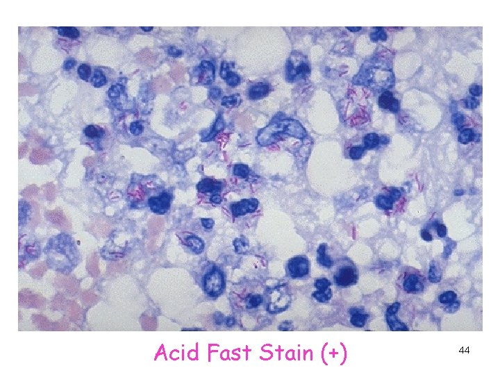 Acid Fast Stain (+) 44 