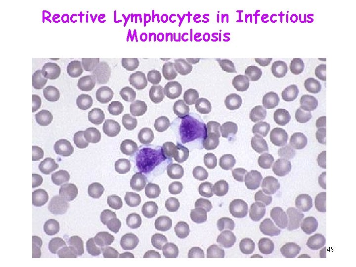 Reactive Lymphocytes in Infectious Mononucleosis 49 