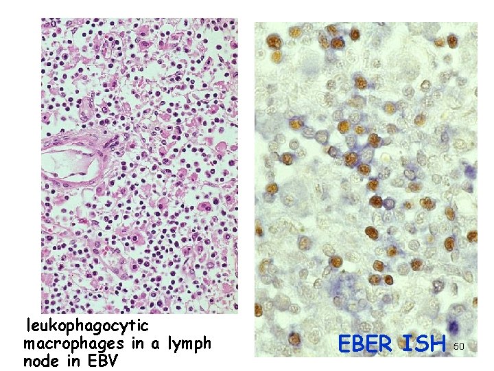 leukophagocytic macrophages in a lymph node in EBV EBER ISH 50 