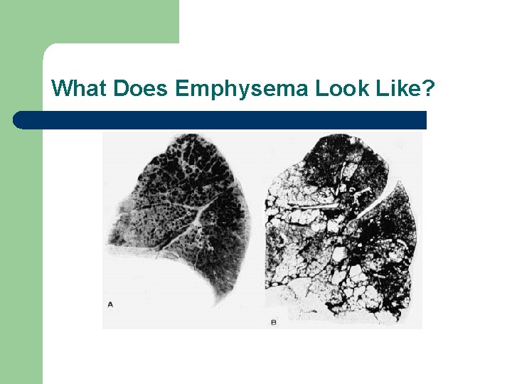 What Does Emphysema Look Like? 