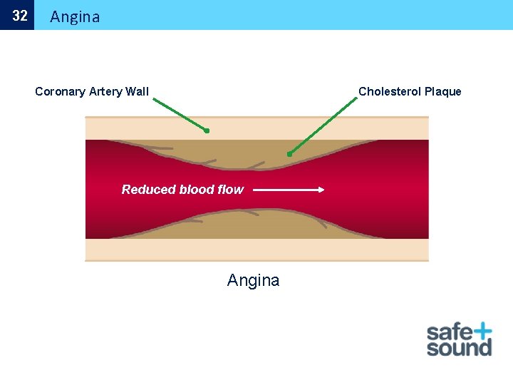 32 Angina Cholesterol Plaque Coronary Artery Wall Reduced blood flow Angina 