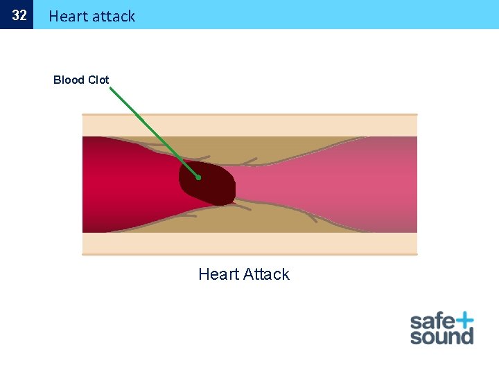 32 Heart attack Blood Clot Heart Attack 