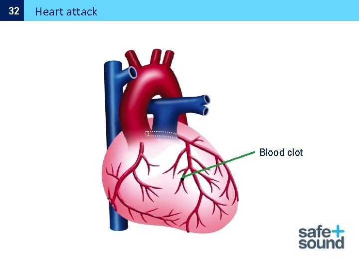 32 Heart attack Blood clot 