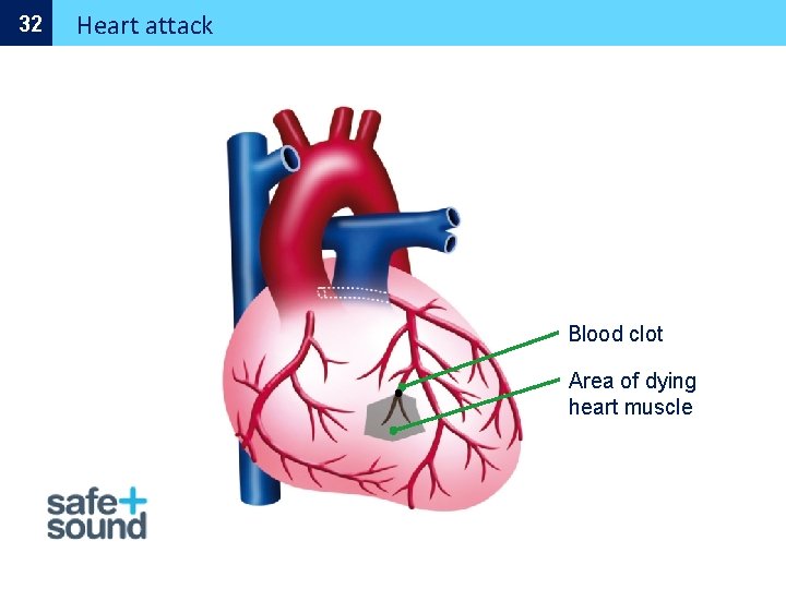 32 Heart attack Blood clot Area of dying heart muscle 