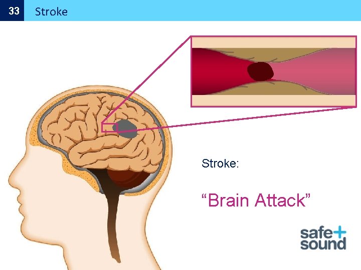 33 Stroke: “Brain Attack” 