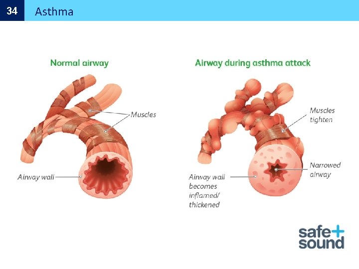 34 Asthma 