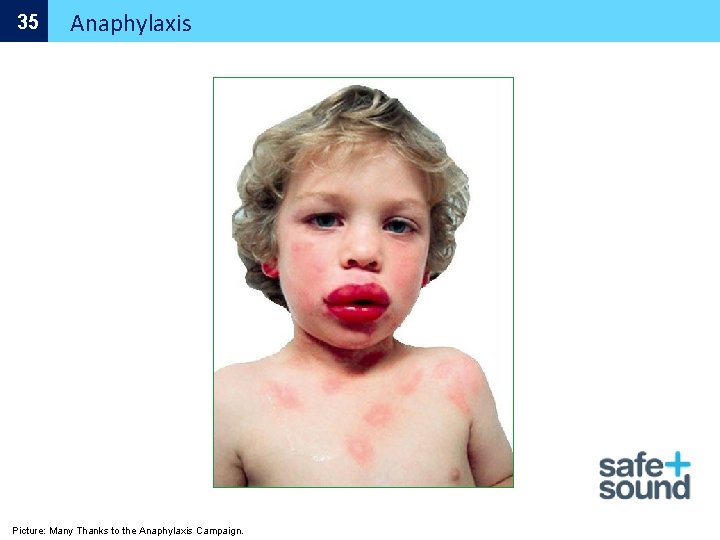 35 Anaphylaxis Picture: Many Thanks to the Anaphylaxis Campaign. 