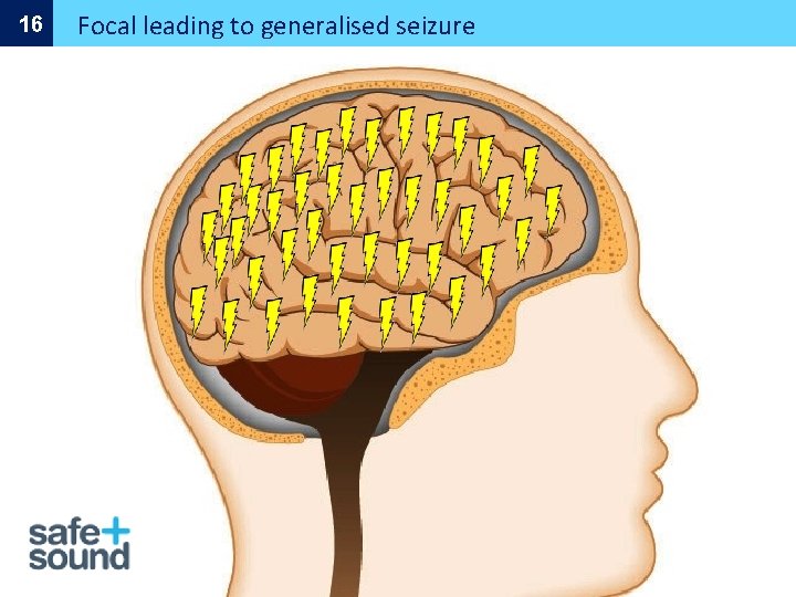 16 Focal leading to generalised seizure 