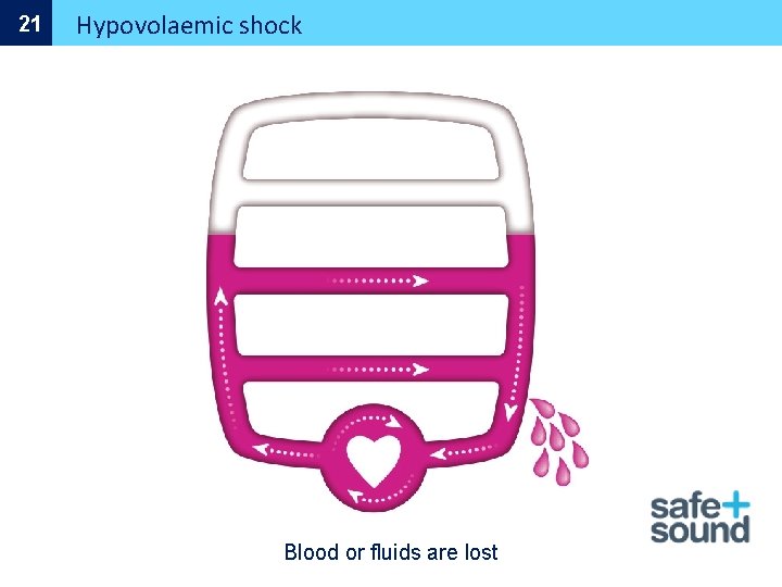 21 Hypovolaemic shock Blood or fluids are lost 