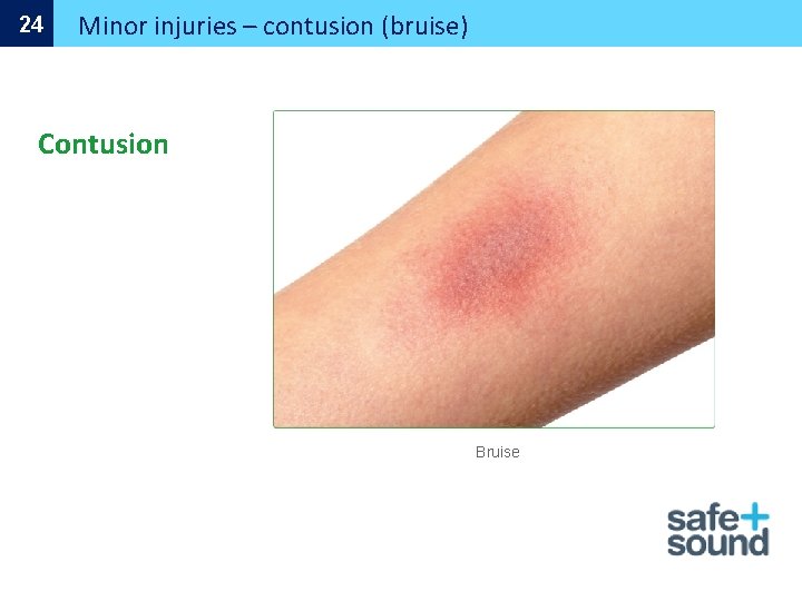 24 Minor injuries – contusion (bruise) Contusion Bruise 