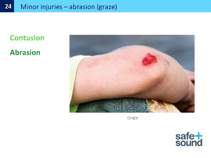 24 Minor injuries – abrasion (graze) Contusion Abrasion Graze 