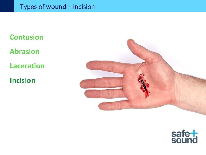 Types of wound – incision Contusion Abrasion Laceration Incision 