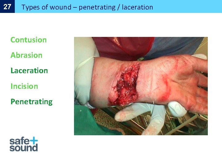 27 Types of wound – penetrating / laceration Contusion Abrasion Laceration Incision Penetrating 