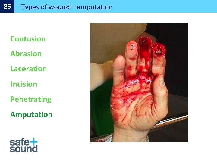 26 Types of wound – amputation Contusion Abrasion Laceration Incision Penetrating Amputation 