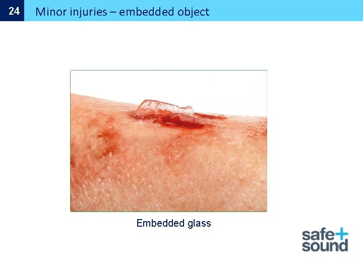 24 Minor injuries – embedded object Embedded glass 