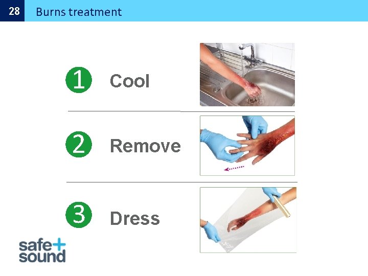 28 Burns treatment 1 Cool 2 Remove 3 Dress 