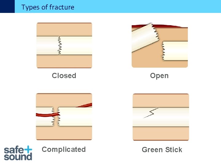 Types of fracture Closed Complicated Open Green Stick 