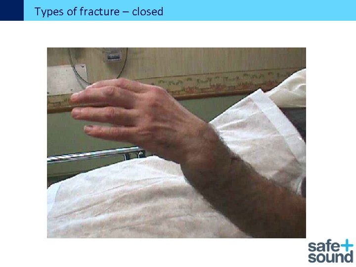 Types of fracture – closed 