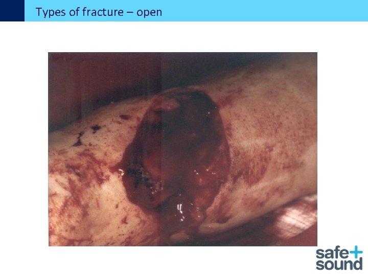 Types of fracture – open 