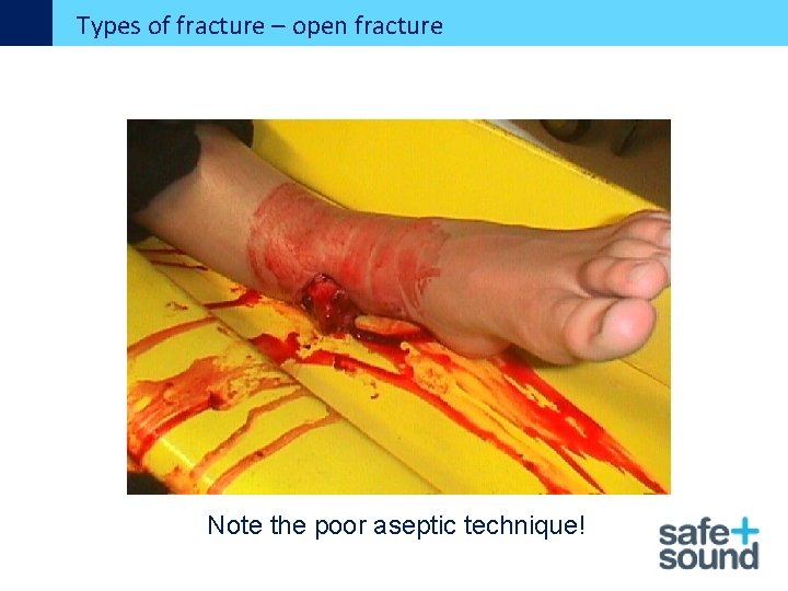 Types of fracture – open fracture Note the poor aseptic technique! 