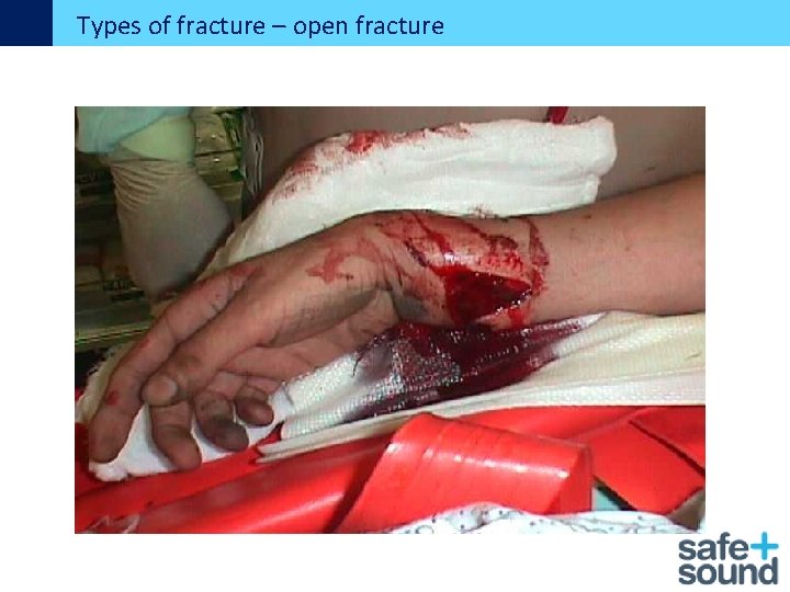 Types of fracture – open fracture 