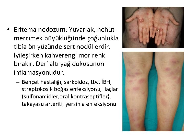 • Eritema nodozum: Yuvarlak, nohutmercimek büyüklüğünde çoğunlukla tibia ön yüzünde sert nodüllerdir. İyileşirken • Eritema nodozum: Yuvarlak, nohutmercimek büyüklüğünde çoğunlukla tibia ön yüzünde sert nodüllerdir. İyileşirken