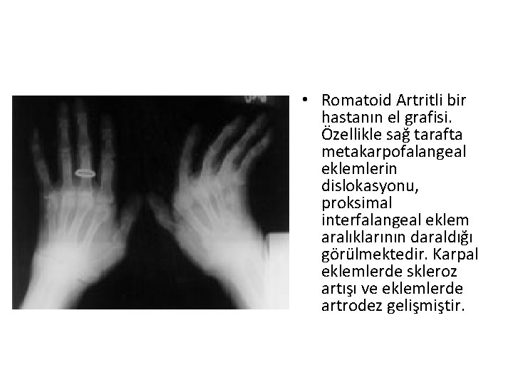 • Romatoid Artritli bir hastanın el grafisi. Özellikle sağ tarafta metakarpofalangeal eklemlerin dislokasyonu, • Romatoid Artritli bir hastanın el grafisi. Özellikle sağ tarafta metakarpofalangeal eklemlerin dislokasyonu,