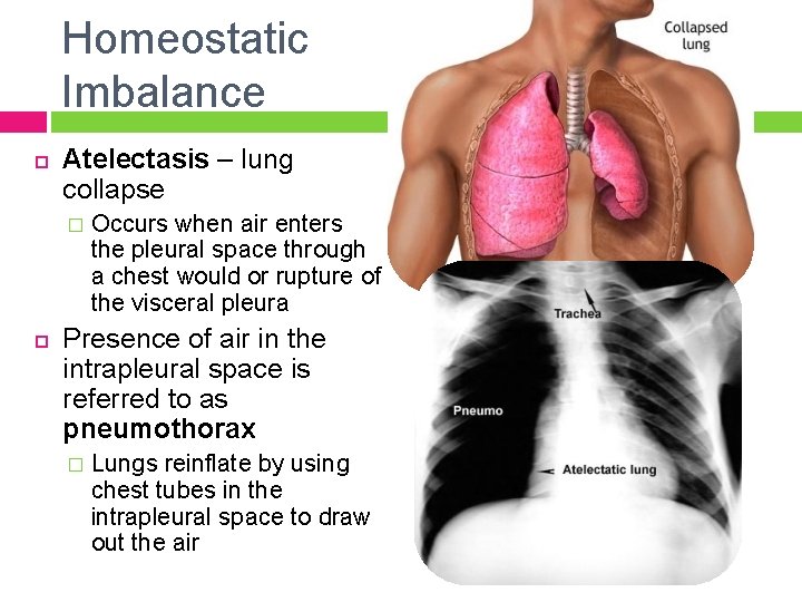 Homeostatic Imbalance Atelectasis – lung collapse � Occurs when air enters the pleural space