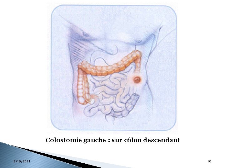 Colostomie gauche : sur côlon descendant 2/19/2021 10 