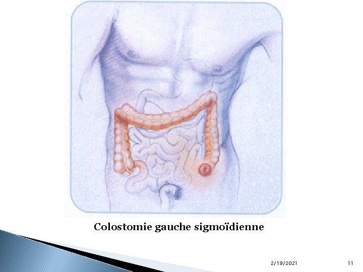 Colostomie gauche sigmoïdienne 2/19/2021 11 