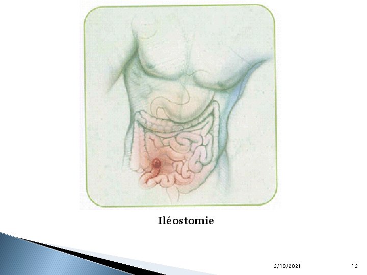 Iléostomie 2/19/2021 12 
