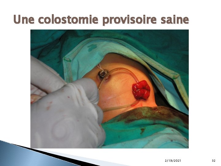 Une colostomie provisoire saine 2/19/2021 32 