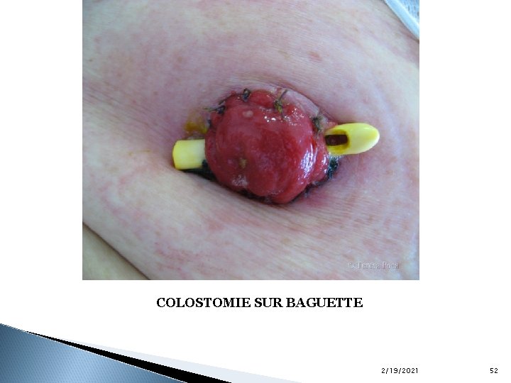 COLOSTOMIE SUR BAGUETTE 2/19/2021 52 