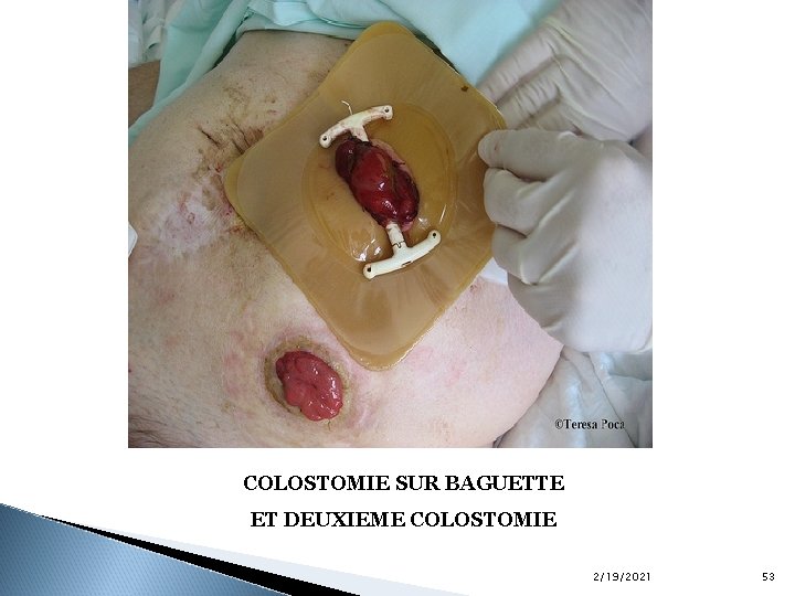 COLOSTOMIE SUR BAGUETTE ET DEUXIEME COLOSTOMIE 2/19/2021 53 