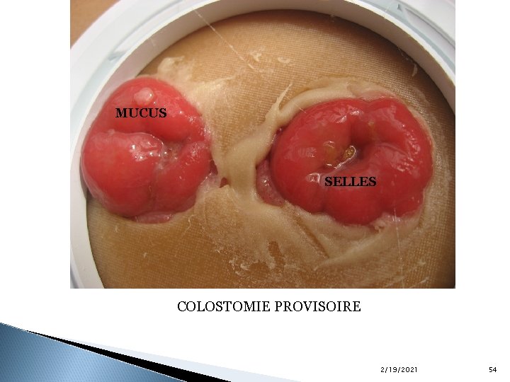 MUCUS SELLES COLOSTOMIE PROVISOIRE 2/19/2021 54 