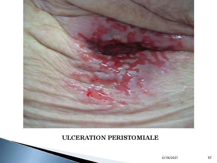 . ULCERATION PERISTOMIALE 2/19/2021 57 