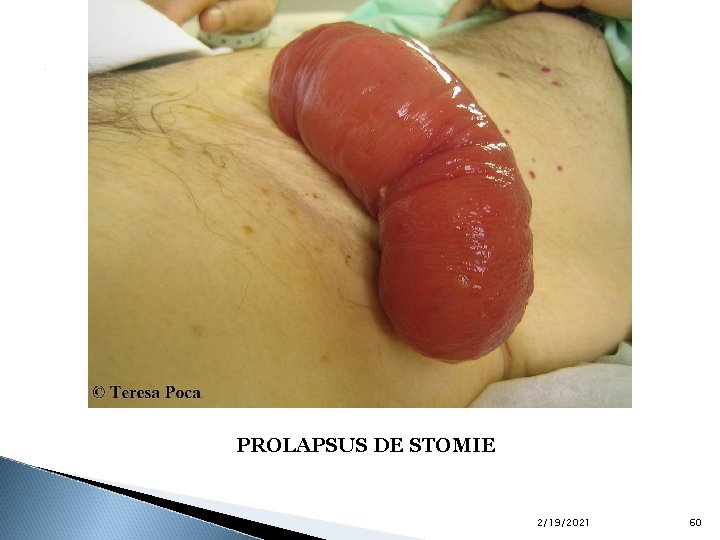 . PROLAPSUS DE STOMIE 2/19/2021 60 