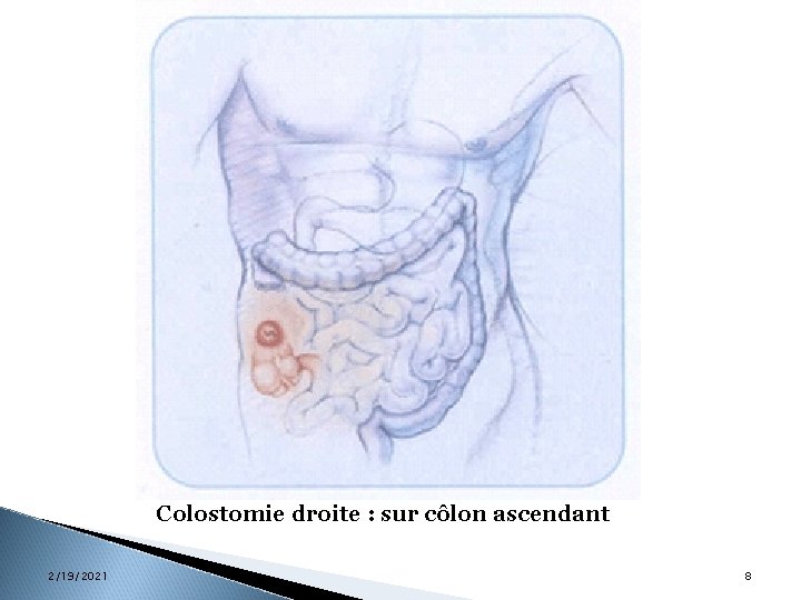 Colostomie droite : sur côlon ascendant 2/19/2021 8 