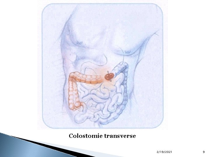 Colostomie transverse 2/19/2021 9 