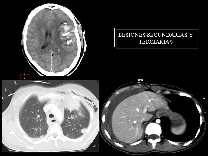 LESIONES SECUNDARIAS Y TERCIARIAS 