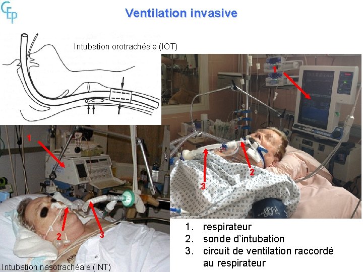 Ventilation invasive Intubation orotrachéale (IOT) 1 1 2 3 Intubation nasotrachéale (INT) 1. respirateur