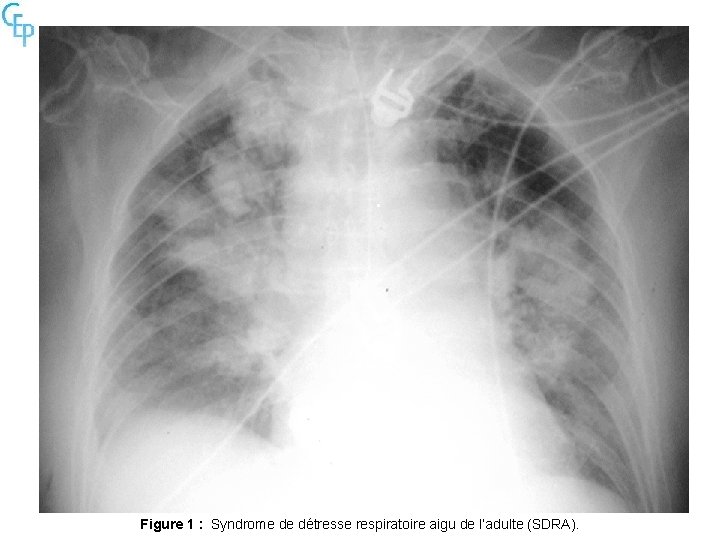 Figure 1 : Syndrome de détresse respiratoire aigu de l’adulte (SDRA). 