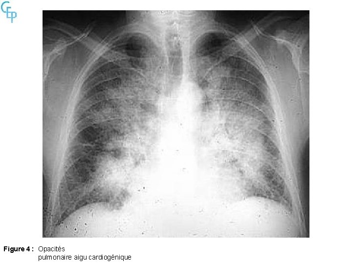 Figure 4 : Opacités pulmonaire aigu cardiogénique 