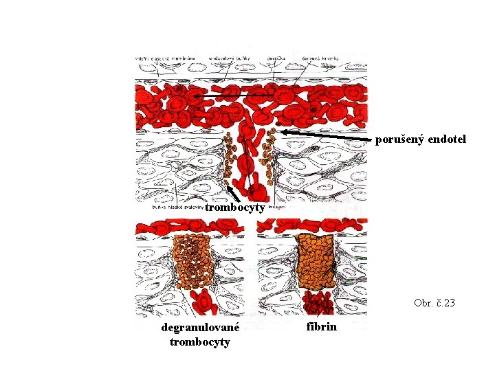 porušený endotel trombocyty Obr. č. 23 degranulované trombocyty fibrin 