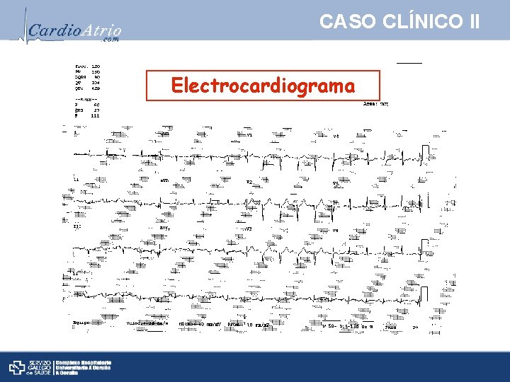 CASO CLÍNICO II Electrocardiograma 