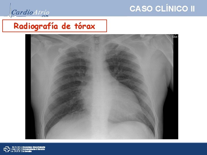 CASO CLÍNICO II Radiografía de tórax 