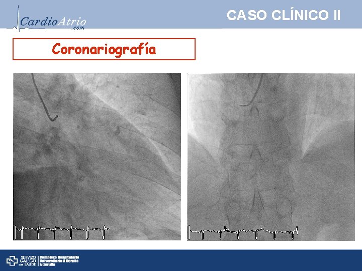 CASO CLÍNICO II Coronariografía 