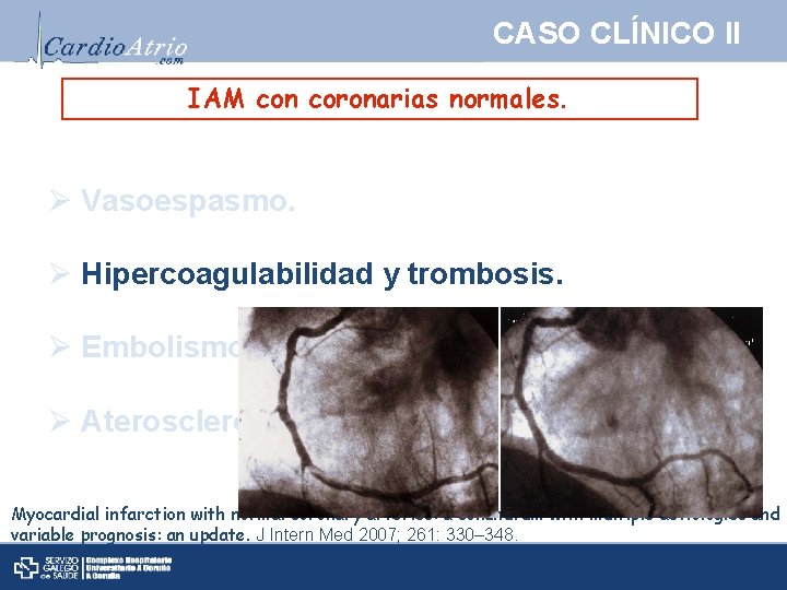 CASO CLÍNICO II IAM con coronarias normales. Ø Vasoespasmo. Ø Hipercoagulabilidad y trombosis. Ø