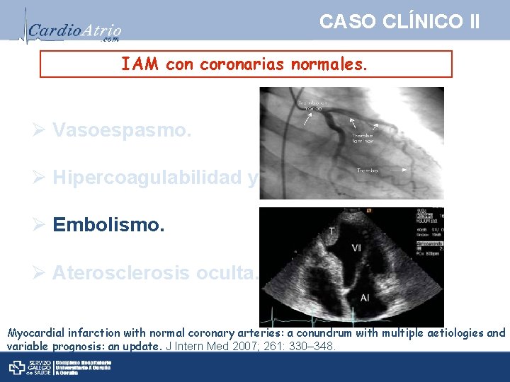 CASO CLÍNICO II IAM con coronarias normales. Ø Vasoespasmo. Ø Hipercoagulabilidad y trombosis. Ø